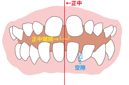 すきっ歯の図解