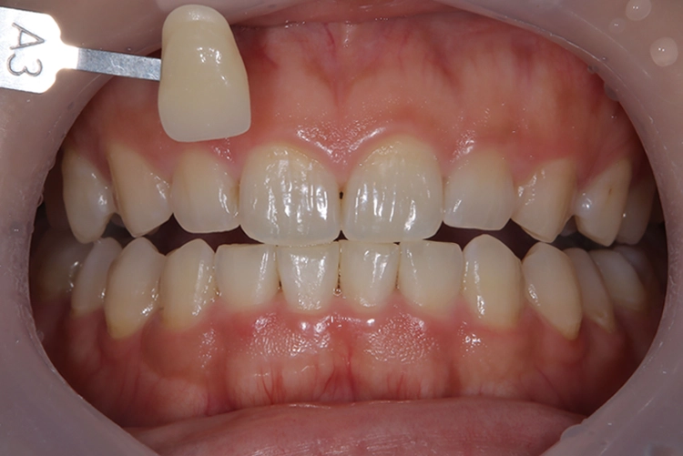ホワイトニング前の歯