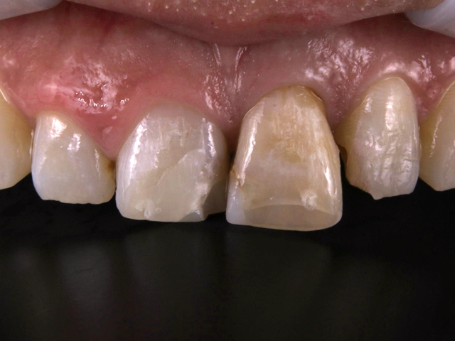 セラミック治療前の前歯