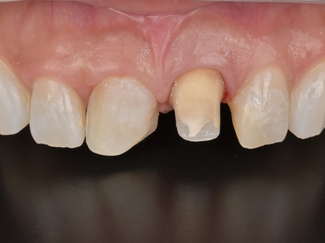 形成が完了した前歯