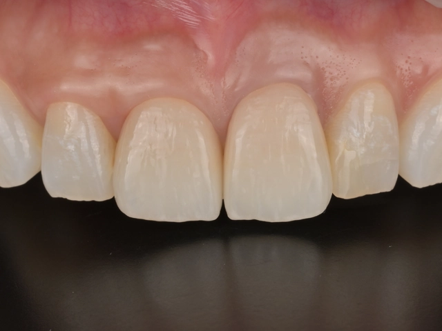 セラミック治療後の前歯