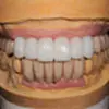 仮歯模型イメージ