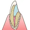 ウォーキングブリーチ中の歯のイメージ