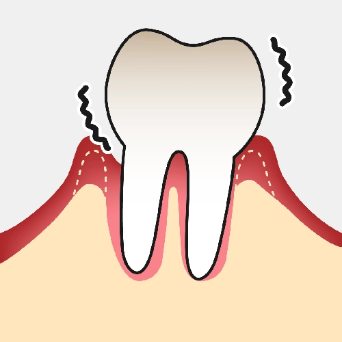歯槽骨が溶けて歯が揺れる