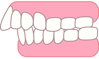 上顎前突のイラスト