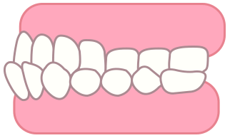 下顎前突のイラスト