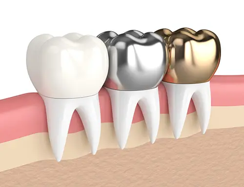 銀歯・金歯・白い歯のイメージ