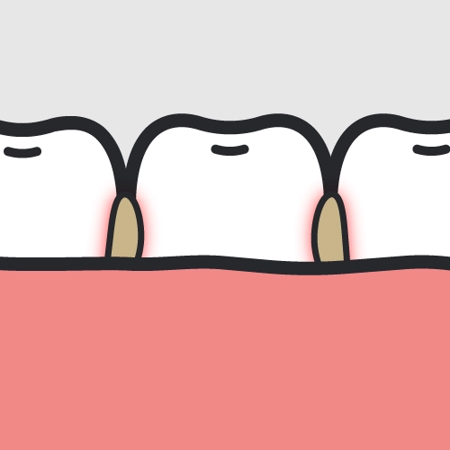 清掃不良で汚れが溜まった口腔内