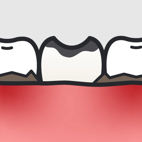 虫歯や歯周病の疑いがある歯