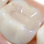 歯の詰め物イメージ